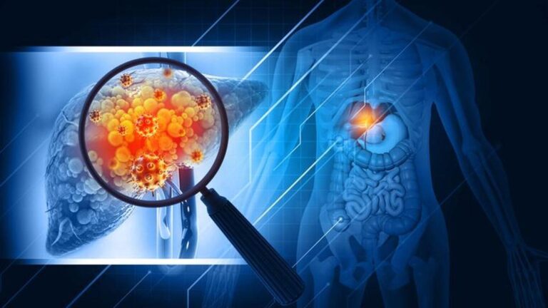 Karaciğer Kanseri Belirtileri Nelerdir? Karaciğer Kanseri Nasıl Anlaşılır? Tedavi Yöntemleri Nelerdir?