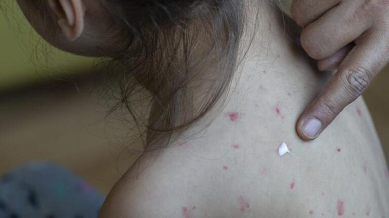 Kızamık Belirtileri Nelerdir? Kızamık Nasıl Anlaşılır? Tedavi Yöntemleri Nelerdir?